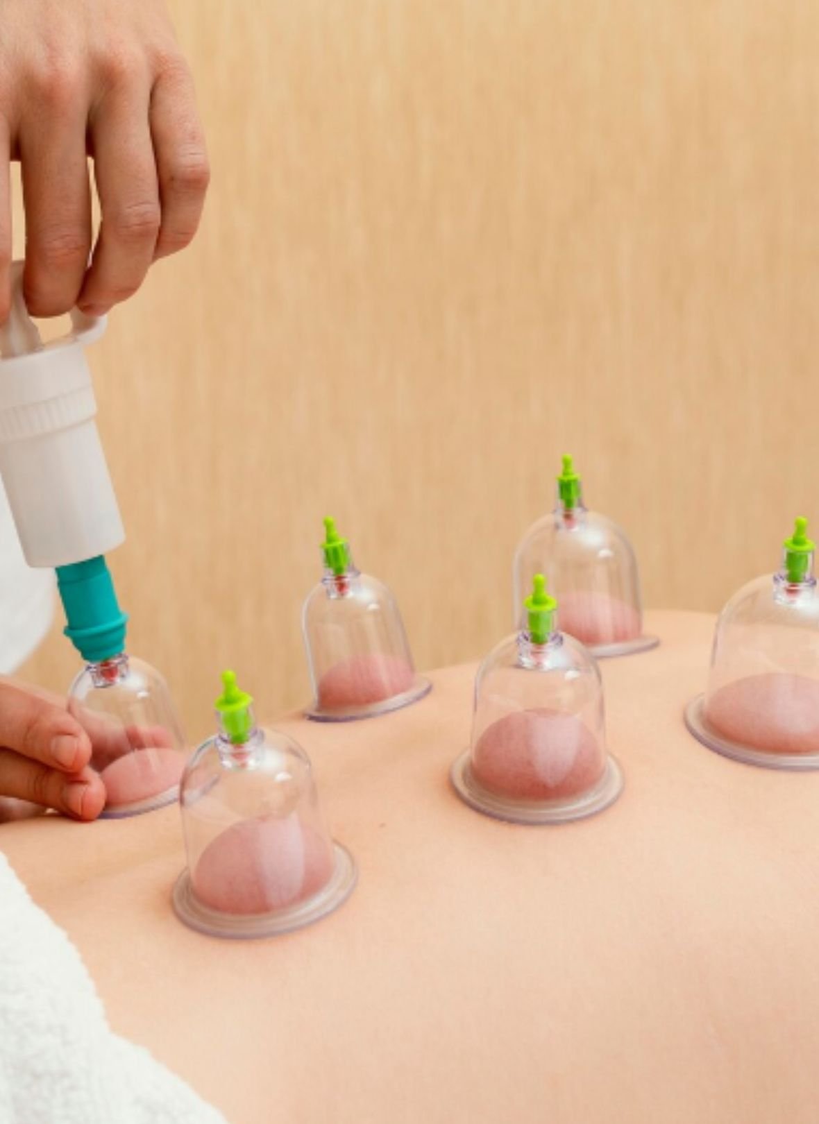 Hijama Therapy