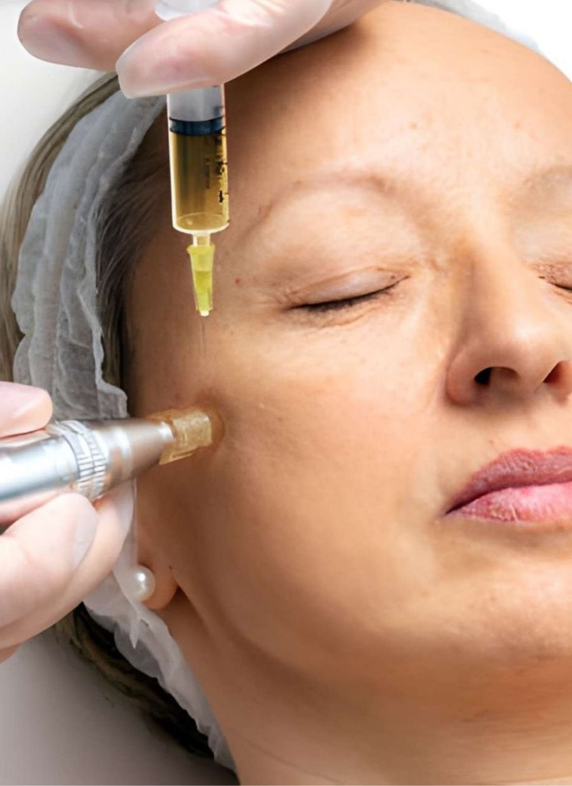 salmon-dna-gold-microneedling